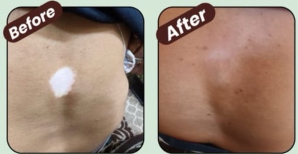 Ayurvedic Vitiligo Cure - Image 8