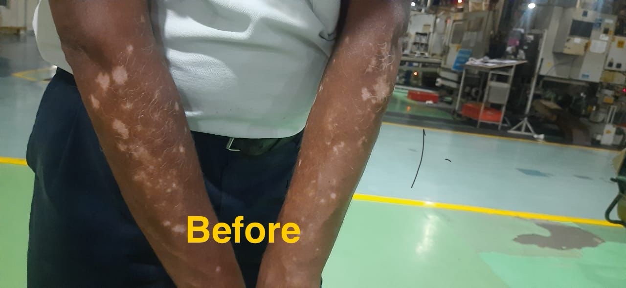 Ayurvedic Vitiligo Cure - Image 4