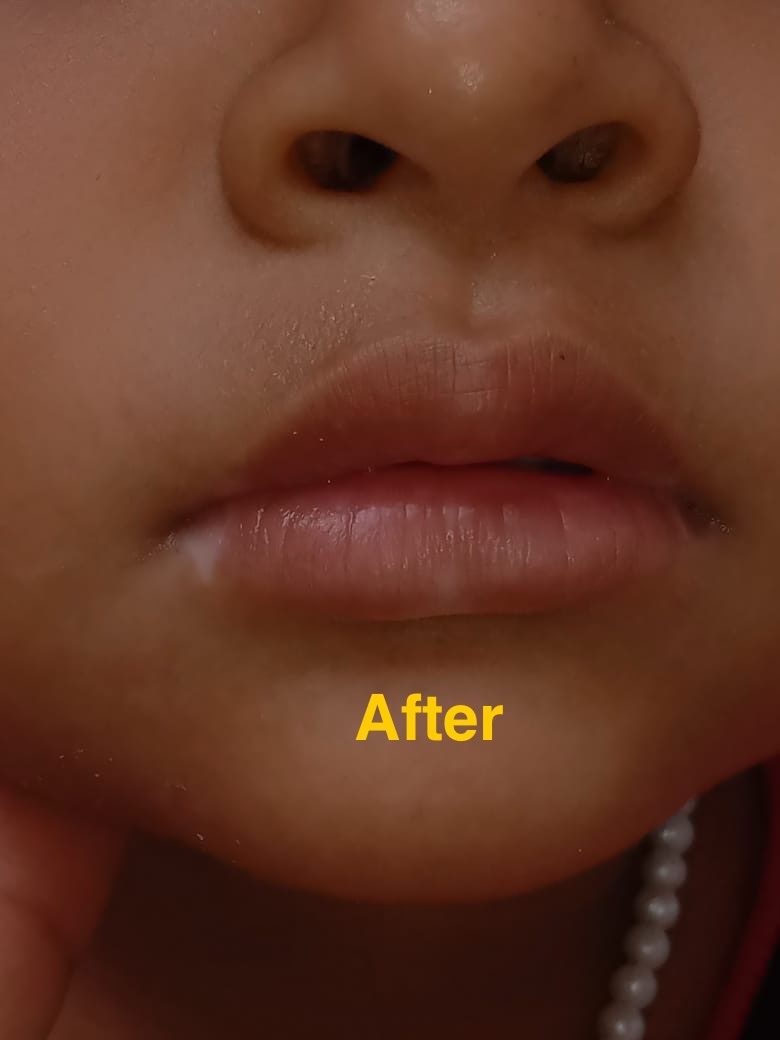 Ayurvedic Vitiligo Cure - Image 7