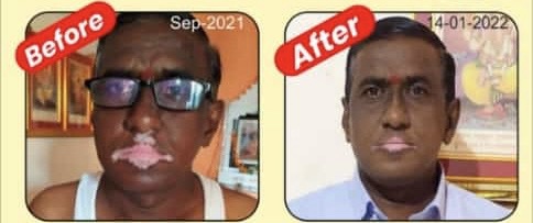 Ayurvedic Vitiligo Cure - Image 9