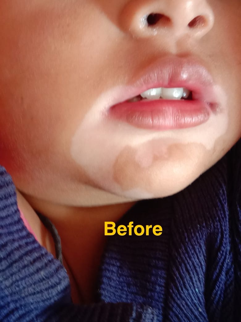 Ayurvedic Vitiligo Cure - Image 6